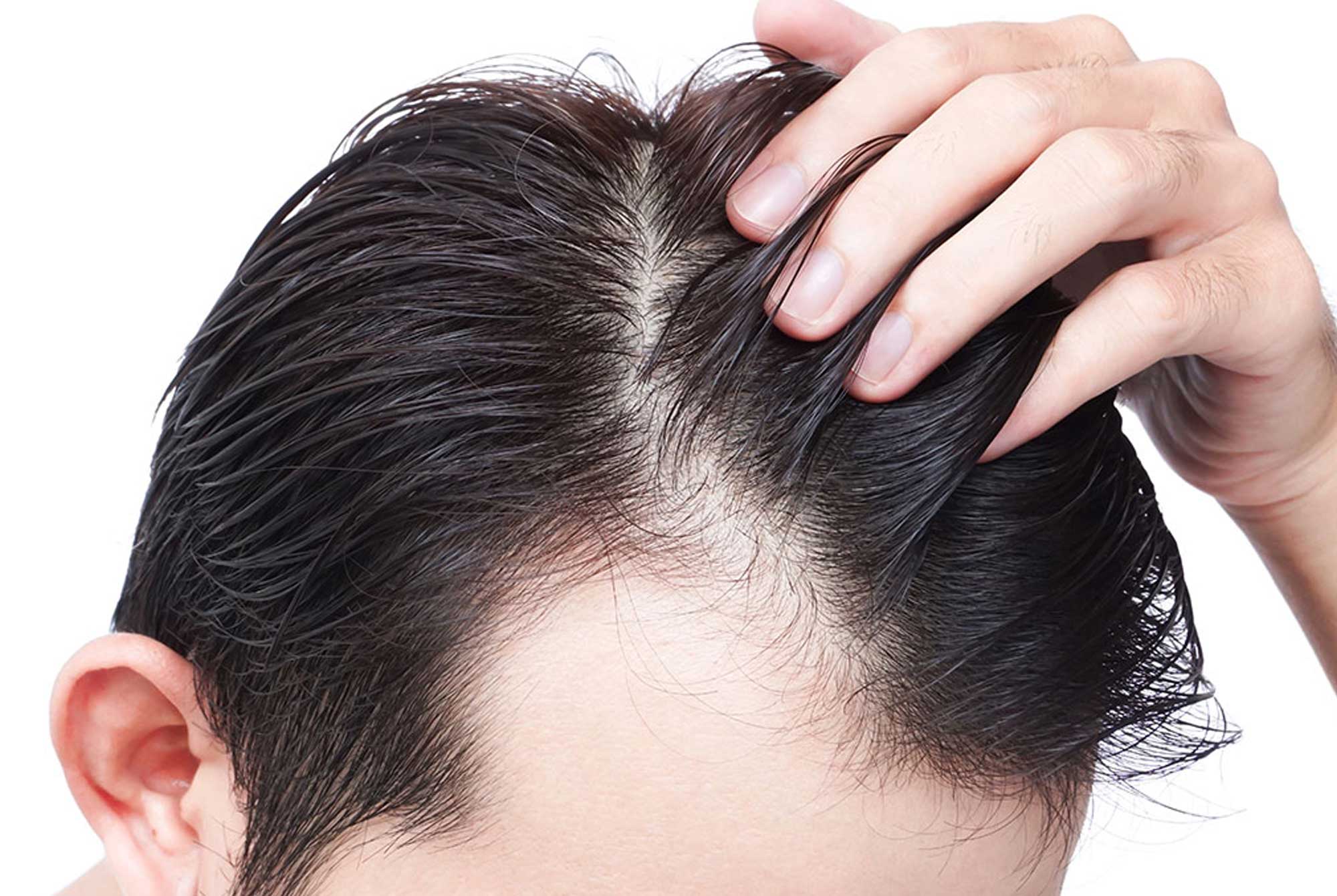 What is Sedated Hair Transplantation? | enahairclinic.com