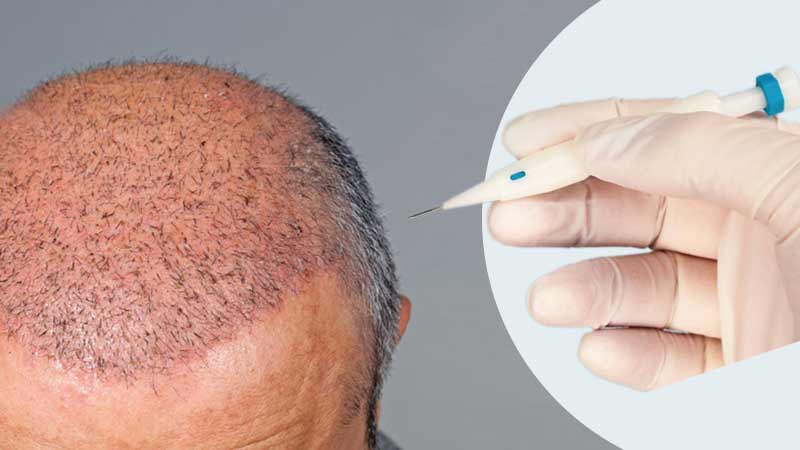 /blog/137/files/df0c4c02-b5cc-4de1-a544-f9b20cde7c66.jpg | Ena Hair Clinic